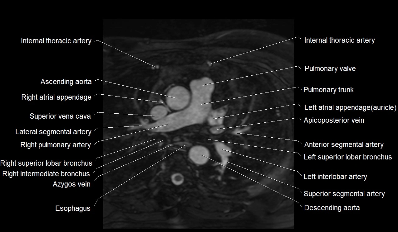 MRI heart coronary arteries and coronary veins anatomy axial image 6.webp